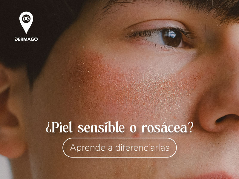 rosacea