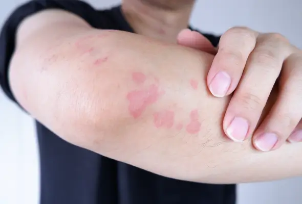 urticaria-dermago