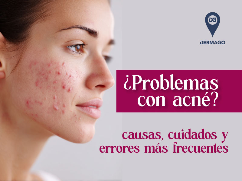 acné en adultos